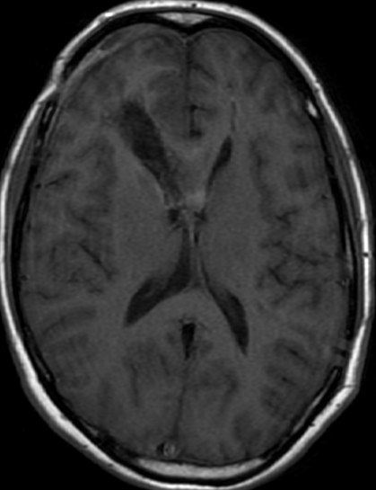 Pseudoprogression Astrocytoma-G3-Idh-wilde - NeuroRad911