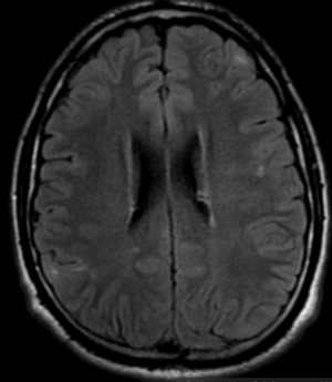 Tuberous sclerosis-subependymal nodules - NeuroRad911