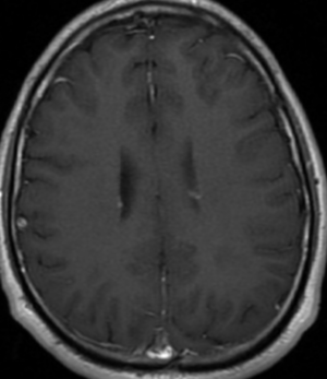 Tuberous sclerosis-subependymal nodules - NeuroRad911
