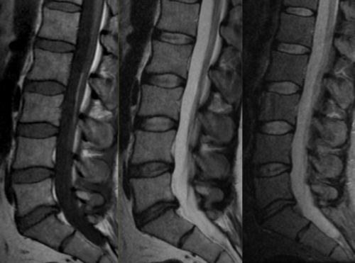 Lipoma of filum terminale | NeuroRad911