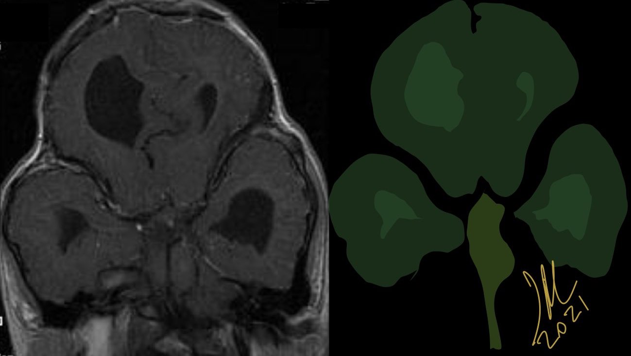 Pfeiffer syndrome type II | NeuroRad911