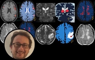 Javier Martínez MD. Graduated from UNC. Diagnostic Residency: Fundación Oulton. Neuroradiology Fellowship at University of Alabama at Birmingham US.