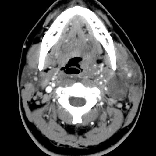 Second Branchial Cleft Cyst Neurorad911 Branchial Cyst