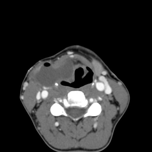 Second branchial cleft Cyst. - NeuroRad911 branchial Cyst