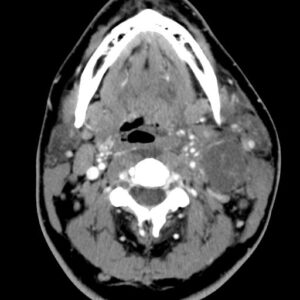 Second branchial cleft Cyst. - NeuroRad911 branchial Cyst