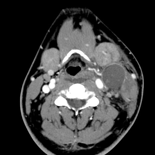 Second branchial cleft Cyst. - NeuroRad911 branchial Cyst