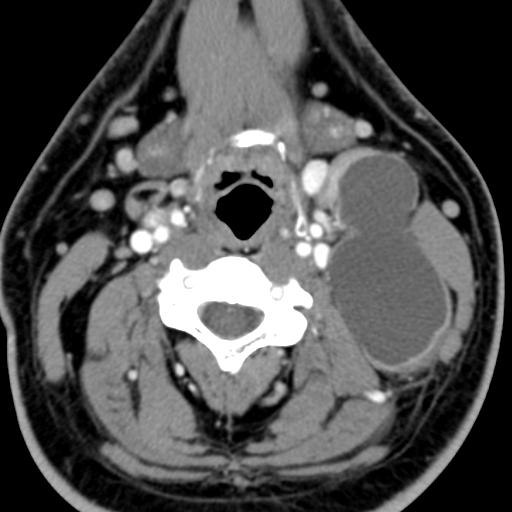 Second branchial cleft Cyst. - NeuroRad911 branchial Cyst